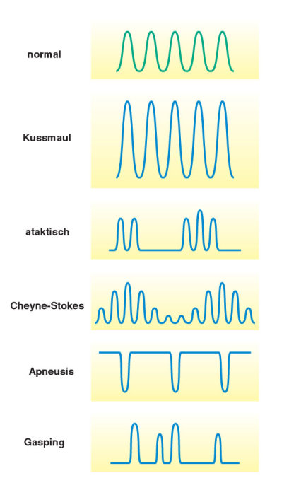 Krankhafte Atemmuster