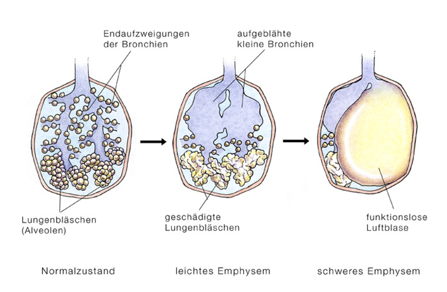 Lungenemphysem