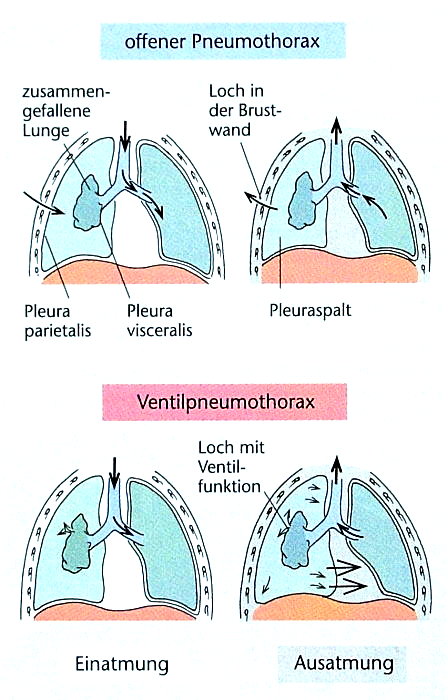 Pneumothorax