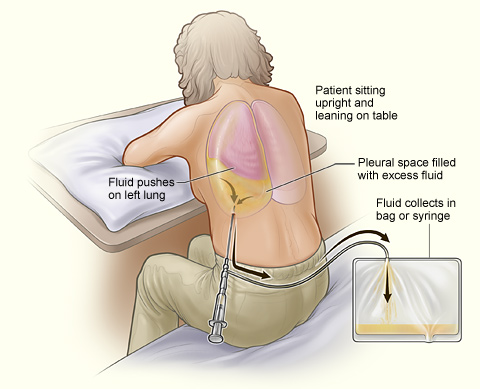 Pneumothorax