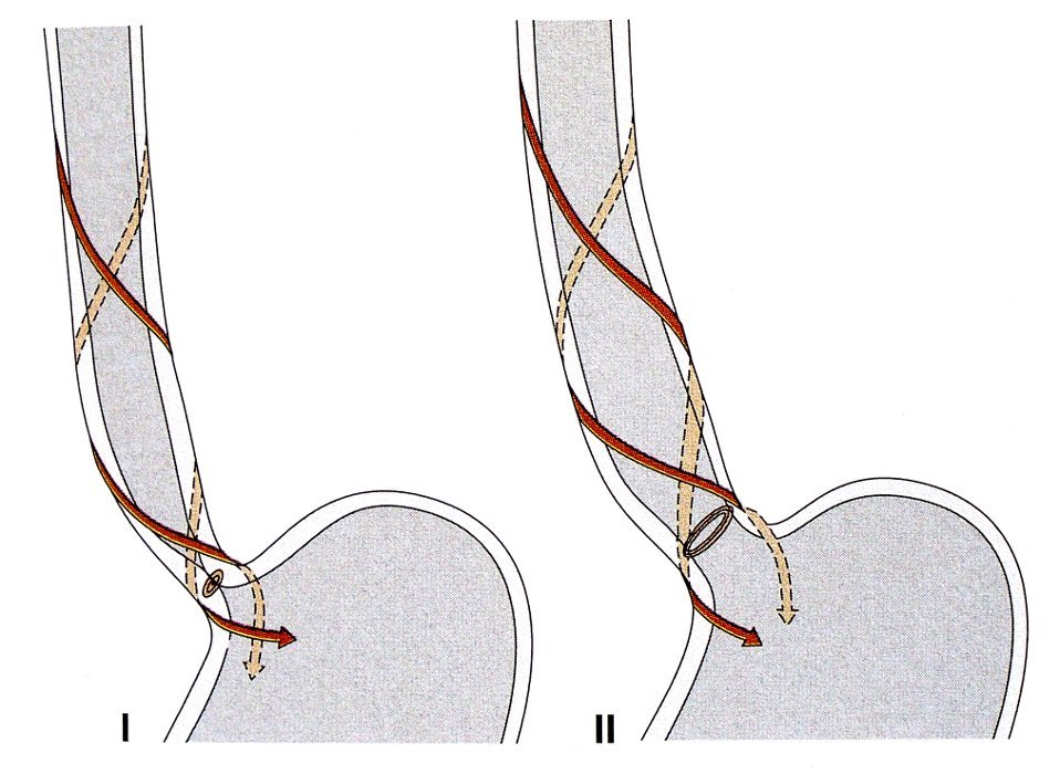 M. sphincter cardiae