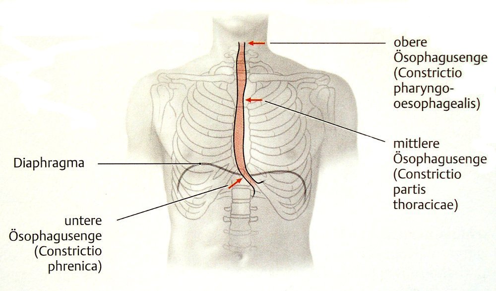 Engstellen des Ösophagus